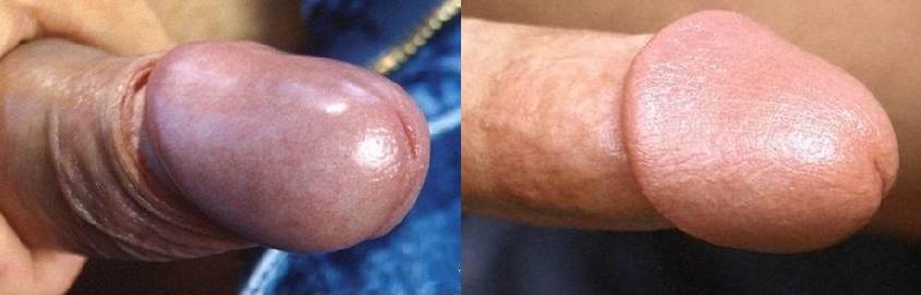 Comparaison de la texture du gland entre un pénis circoncis et intact