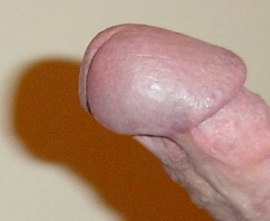 Pont de peau sur un pénis circoncis