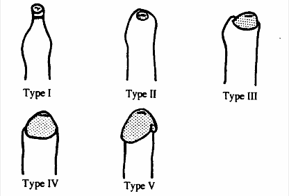 Classification des pénis observés après rétraction du prépuce dans l'étude de Kayaba publiée en 1996