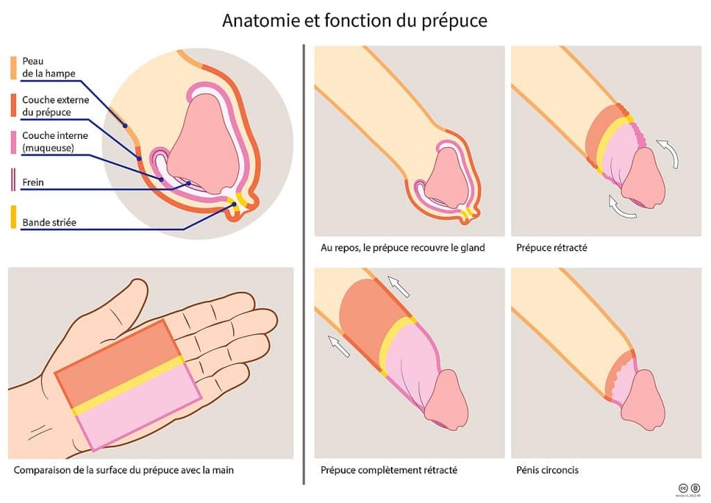 Schéma du prépuce recouvrant le gland, décalotté et circoncis